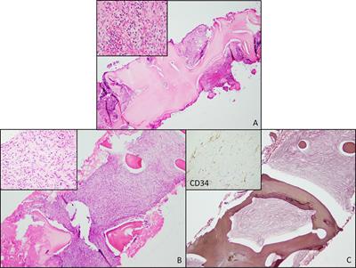 Adult-onset multifocal kaposiform hemangioendothelioma in the bone marrow, lung, liver, and brain: a case report